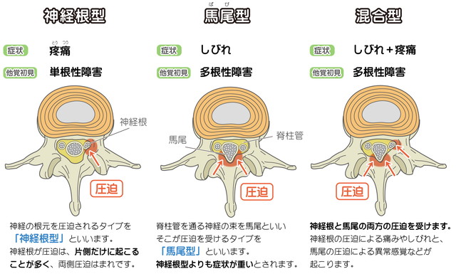 脊柱管狭窄症の種類