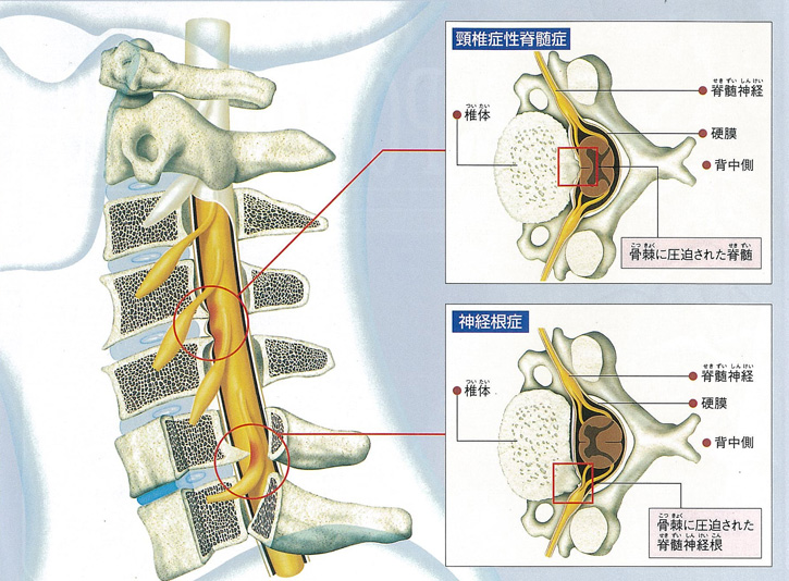 変形性頸椎症（頸髄症・神経根症）の上肢痛に対するエビデンス－リハビリ（理学療法・作業療法）
