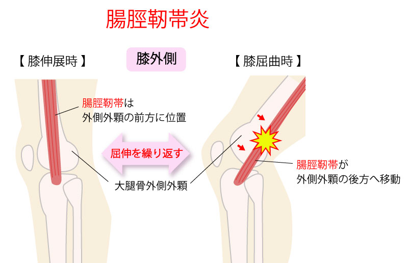 腸脛靭帯炎の解消 予防に必要な情報を公開するよ