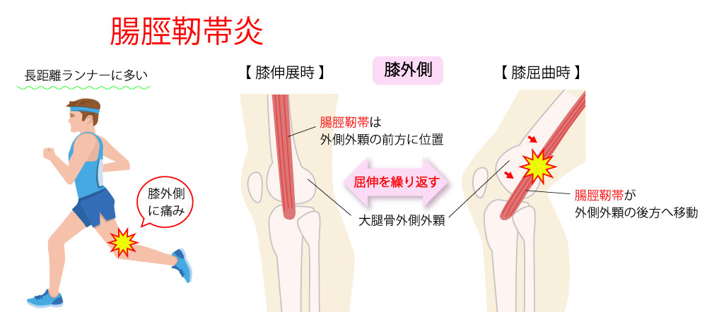 腸脛靭帯炎の解消 予防に必要な情報を公開するよ