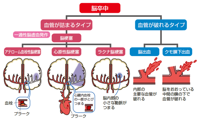 脳性麻痺ハンドブック―療育にたずさわる人のために (お得に買い物でき