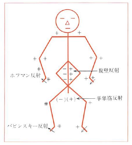 反射検査 深部腱反射 病的反射 とは 意義 種類 記録法などを紹介