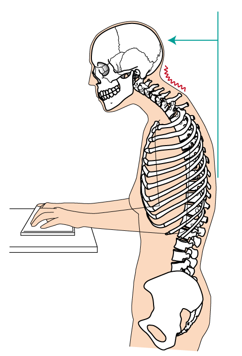 頭部前方位姿勢(Forward Head Posture)