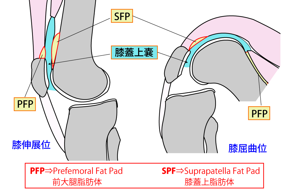 PFP(Prefemoral fat pad・膝蓋上脂肪体)とSFP(Suprapatella fad pad・前大腿脂肪体)